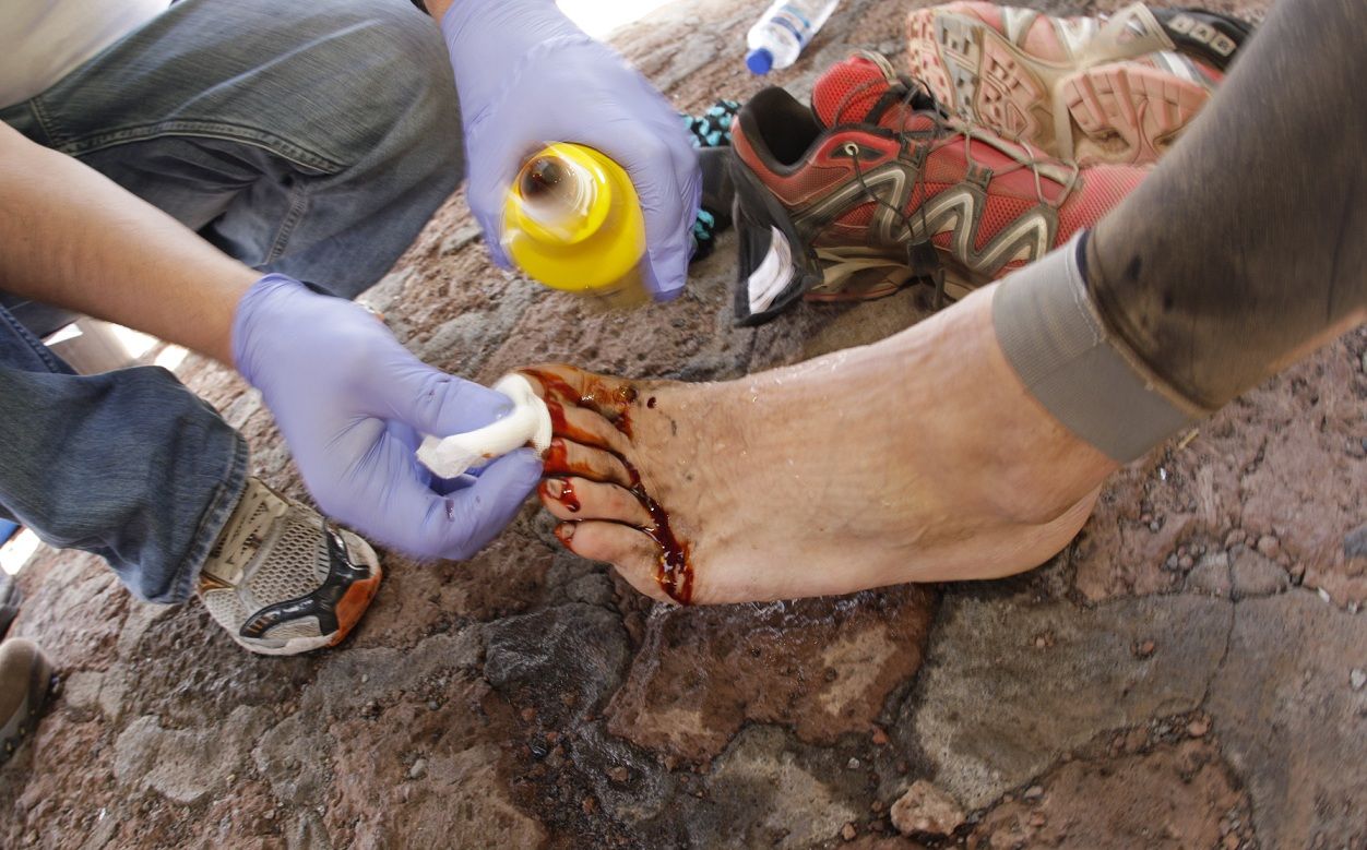 Callos en los pies qué son y cómo tratarlos  DevorOlor