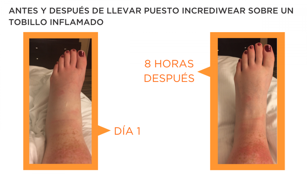 Inflamación de Tobillo 3 Inflamación de Tobillo 3